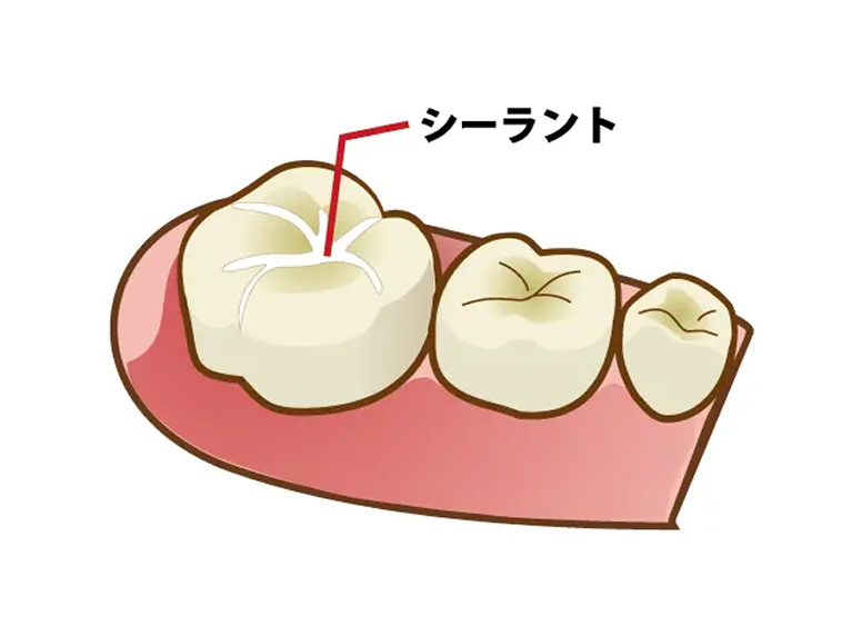 シーラント